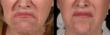 New Uses For Botox: It Isn't Just For Wrinkles Anymore